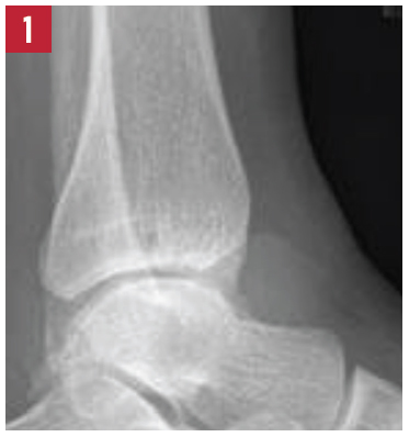 X-ray of the left ankle.