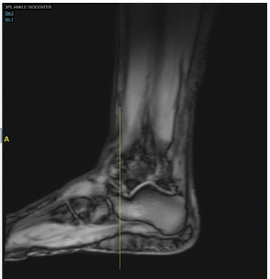 T2-weighted image of the left ankle.