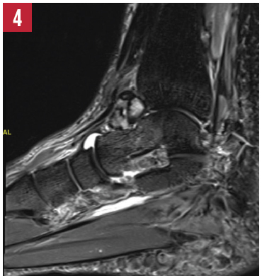 STIR image of the left ankle.