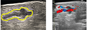 Figure 7: An irregular heterogeneous mass under nail on B Mode and a highly vascular discrete lesion on color Doppler.