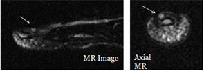 Figure 8: POCUS is used to guide an MRI study of a nail bed.