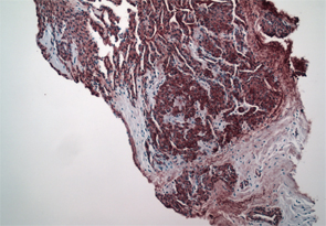 Figure 9: Smooth muscle actin immunostain shows smooth muscle surrounding vascular channels and neural elements. Courtesy of David Chercover, MD, Lions Gate Hospital, North Vancouver, B.C.