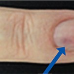 Figure 2: The nail bed shows some discoloration.