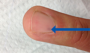 Figure 5: A splinter-shaped bluish discoloration under the nail bed.