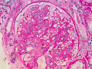 Figure 1: Renal biopsy. H&E staining: enlarged glomeruli, mesangial expansion with diffuse increased cellularity; glomerular basement membranes irregularly thickened, but no vasculitis, necrotizing lesions, crescents or hyaline thrombi were seen within the capillary loops.