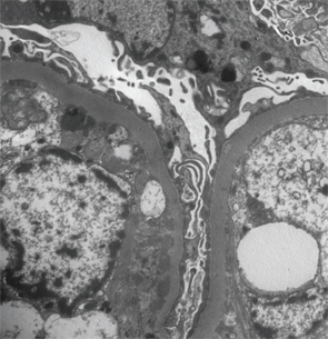 Figure 2: Renal biopsy. Electron microscopy: irregular thickening of the glomerular basement membrane with a few scattered subendothelial electron dense deposits, focal neomembrane formation, an expanded mesangium and podocyte foot processes effacement.