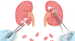 Rheumatoid Arthritis & Autoimmune Glomerulonephritis