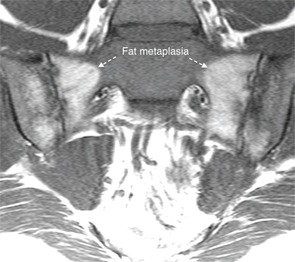 How Magnetic Resonance Imaging Technology Can Aid Spondyloarthritis Diagnosis