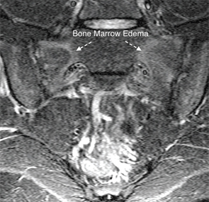 These images illustrate the two MRI sequences that can be used together to diagnose spondyloarthritis in the sacroiliac joint, as described by Dr. Maksymowych. The T1-weighted MRI scan of the sacroiliac joint in the semi-coronal plane (top) is a fat-sensitive sequence, so subcutaneous fat appears bright. This scan is abnormal because it shows two large areas of bright signal in the sacrum adjacent to subchondral bone characterized by a homogeneous appearance and a distinct border. A STIR scan of the sacroiliac joint in the semi-coronal plane (bottom), taken from the same patient, is a water-sensitive scan with blood vessels and cerebrospinal fluid appearing bright. This scan is abnormal because it shows areas of bright signal in the subchondral bone marrow of the sacrum, a sign of bone marrow edema. When both figures are viewed together, you can see that the area of bone marrow edema surrounds the area of fat metaplasia on the T1W scan—typical of inflammation that is resolving, but still remains active, in a patient with spondyloarthritis.