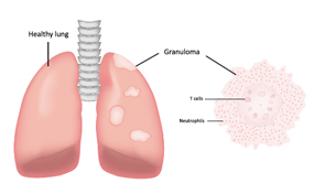 One severe life-threatening vasculitis is granulomatosis with polyangiitis.