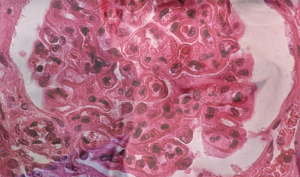 The pattern of lupus glomerular involvement in this patient with lupus nephritis is similar to that in membranous nephropathy, forming wire-loops lesions.
