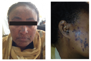 This patient with SLE presented to the Black Lion Nephrology Clinic with an old discoid rash.