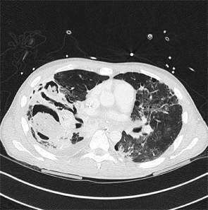 An axial CT view demonstrating a mycetoma in the right lower lobe.