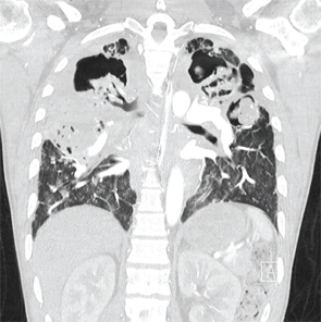 A coronal CT view demonstrating right and left upper lobe mycetomas.