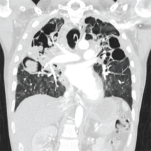 A coronal CT view demonstrating right upper and middle lobe mycetomas.