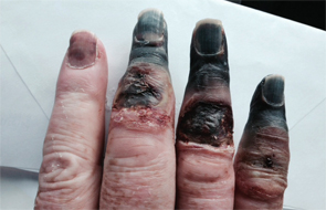 The patient’s necrotic digits on his right hand had to be amputated.