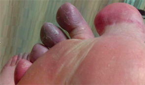 The patient’s first to fourth digits on his right foot had a bluish discoloration, as did his forefoot. 