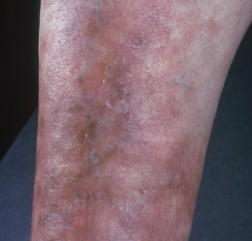 Vasculitis, the inflammatory destruction of blood vessels, is often an accompanying symptom of a rheumatic disease. 