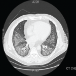 How to Diagnose Antisynthetase Syndrome