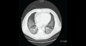 How to Diagnose Antisynthetase Syndrome