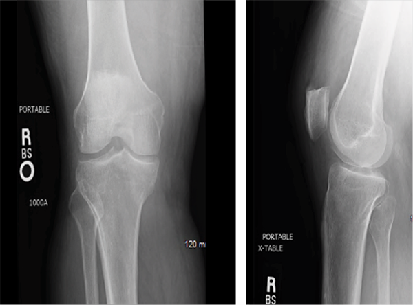 Figures 1 & 2: X-rays of the Right Knee