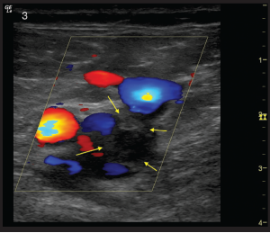 Figure 3: A transverse view of the right common femoral and saphenous junction again visualized with Color Flow Doppler mode. Flow is present in the common femoral artery and saphenous vein. A clot in the common femoral vein (outlined by yellow arrows) can be seen as a filling defect with flow seen around the clot. 