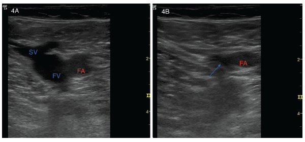 Figures 4A and B: (Left) A transverse view of a normal left common femoral artery (FA), left common femoral vein (FV) and left saphenous vein (SV). (Right) Light compression collapses the saphenous vein, and the blue arrow points to the collapsed region of the left common femoral vein. The femoral artery (FA) remains patent.