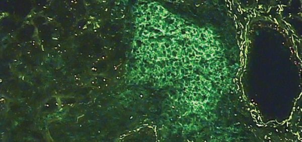 Photomicrograph of the salivary gland of a person with Sjögren’s syndrome, characterized by the abnormal migration of of lymphocytes T and B. Here only the lymphocytes B appear in green.