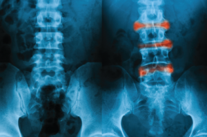 This L-S spine X-ray image, AP view, depicts a comparison of a normal (left) and ankylosing spondylitis (right) lumbar.