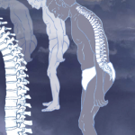 An illustration of ankylosing spondylitis, which commonly affects the joints between the spinal bones and the sacroiliac joints, which link the spine to the pelvis. The joints become painful and stiff. In severe cases, the vertebrae may fuse together completely. The condition is treated with painkillers and regular exercise.