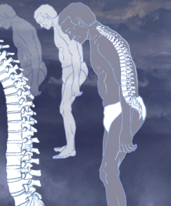 An illustration of ankylosing spondylitis, which commonly affects the joints between the spinal bones and the sacroiliac joints, which link the spine to the pelvis. The joints become painful and stiff. In severe cases, the vertebrae may fuse together completely. The condition is treated with painkillers and regular exercise.