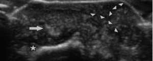 Figure 4: Ultrasound Image of the Bullous Lesion