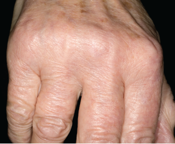 Osteoarthritis Hand