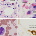 Fellows' Forum Case Report: Hemophagocytic Lymphohistiocytosis