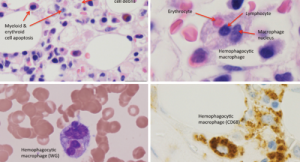 Fellows' Forum Case Report: Hemophagocytic Lymphohistiocytosis