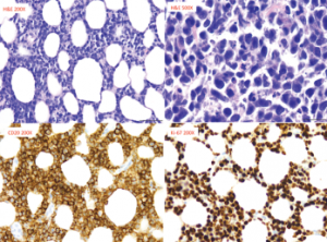 Figure 3: Pathology from Right Breast Core Biopsy