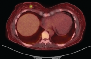Figure 2: Fused PET-CT Image
