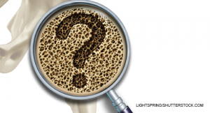Osteoporosis Screening Is Underutilized Despite Recommendations