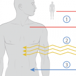 HSCT for Severe Autoimmune Diseases