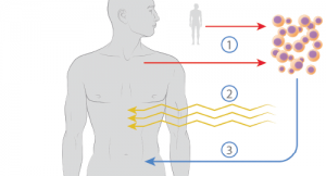 HSCT for Severe Autoimmune Diseases