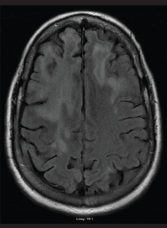 An MRI of the brain performed without contrast on June 25, 2016, showed extensive and nonspecific signal abnormalities in the cortical ribbon and subcortical white matter of the right frontal lobe. There is minimal associated parenchymal atrophy in this region without evident edema. No pathologic enhancement, diffusion restriction nor hemosiderin deposition were associated with such signal abnormality.