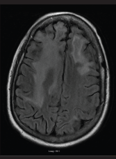 An MRI of the brain performed without contrast on July 7, 2016, showed persistent abnormalities in the frontal lobes, which in the right extended into the anterior adjacent parietal lobe. The abnormalities were greater in the right lobe than in the left. Findings in the occipital lobes did not have convincing evidence of restricted diffusion or hemorrhage.