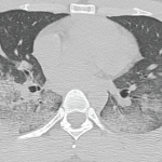 A CT scan of the chest showing multifocal ground-glass opacities, representative of hemorrhage, with numerous nodular interstitial opacities primarily within a peribronchovascular distribution.