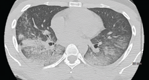A CT scan of the chest showing multifocal ground-glass opacities, representative of hemorrhage, with numerous nodular interstitial opacities primarily within a peribronchovascular distribution.
