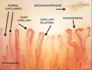 Microhemorrhages represent the death of the giant capillaries. Their disappearance from the microvessel array, with consequent loss of capillaries, is followed in advanced stages by angiogenesis and the formation of new, abnormal vessels.