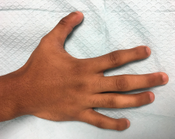Figure 2. This image of the right hand gives us a closer view of the fourth and fifth digits; however, the mild extension of the proximal interphalangeal joints is not well visualized in the picture.