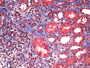 Figure 4. Minimal fibrosis