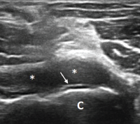 Figure 2. Ultrasound of the left elbow: anterior transverse view of the radial aspect of the joint. A large anechoic collection (*) is present in the anterior radial joint space. There is a hyperechoic linear band (arrow) over the superficial margin of the hyaline cartilage of the humeral capitellum (C). 