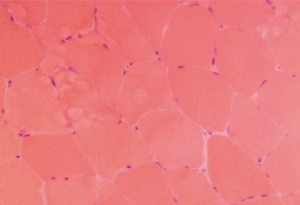 This H&E stain of Patient 1’s muscle biopsy shows normal muscle with minimal necrosis.