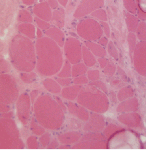 This H&E stain of Patient 2’s muscle biopsy shows necrotic muscle fibers with mild inflammatory cell infiltration.
